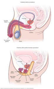 transgender surgery thailand