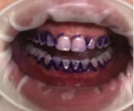 teeth before photo
