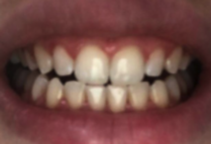 teeth after photo