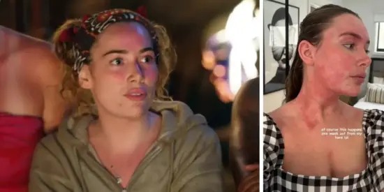 Survivor's Logan explains her 'really, really red' skin condition seen at Tribal Council